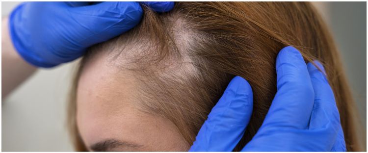 Tak perlu serum rambut, begini trik mudah tumbuhkan rambut pitak samping hanya pakai 2 bahan dapur