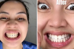 Trik mencerahkan gigi kuning akibat plak membandel pakai 1 bahan alami, bukan dengan kunyit