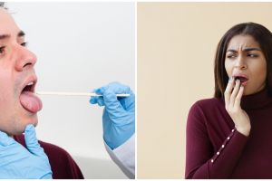 Dikira sariawan biasa ternyata kena kanker lidah, pahami gejala awal, penyebab, dan cara mencegahnya