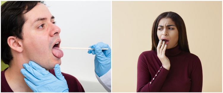 Dikira sariawan biasa ternyata kena kanker lidah, pahami gejala awal