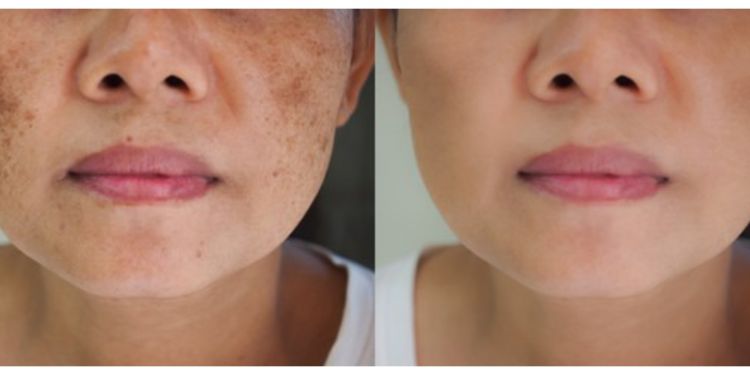 Trik cerahkan flek hitam dan wajah kusam pakai 1 jenis buah, bukan dengan air mawar