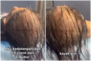 Tampilan cewek rambut tipis hampir botak usai treatment ini hasilnya bak pakai hair extension
