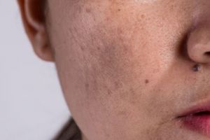 Tak perlu kopi dan lemon, begini cara pudarkan flek hitam akibat hiperpigmentasi pakai 1 jenis rempah