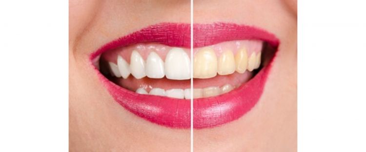 Tak perlu lemon, ini cara hilangkan noda kuning di gigi agar kembali putih dengan 1 bumbu dapur