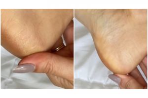 Tak perlu petroleum jelly, ini cara lembutkan tumit retak dan kasar pakai 2 jenis minyak alami