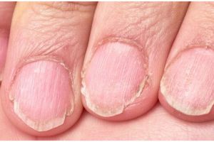 Bukan pakai baking soda, ini cara atasi jamur kuku menguning dengan 1 bahan dapur