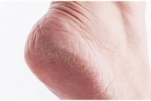 Tanpa petroleum jelly, ini trik melembutkan tumit kaki pecah-pecah pakai 1 bahan sederhana