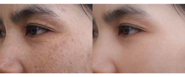 Flek hitam akibat hiperpigmentasi bisa dipudarkan dengan 1 jenis tepung, ampuh meski tanpa yoghurt