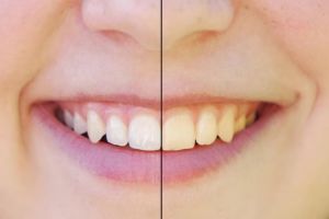 Putih tanpa bleaching, campuran kulit pisang dan 2 bahan dapur ini ampuh bersihkan gigi bernoda kuning