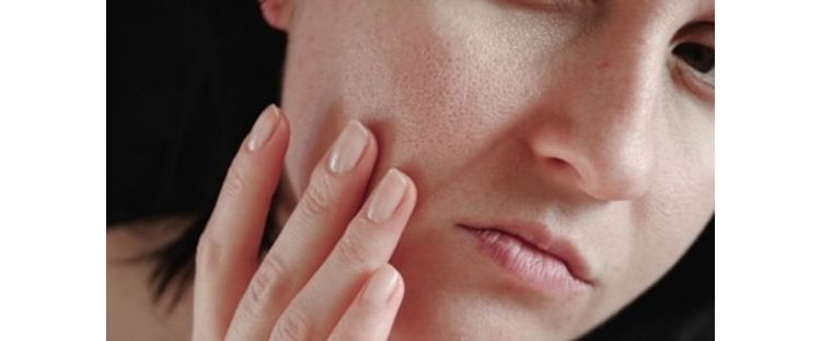 Trik kecilkan pori-pori wajah dan hilangkan komedo tanpa tomat, ampuh pakai 2 jenis tanaman herbal