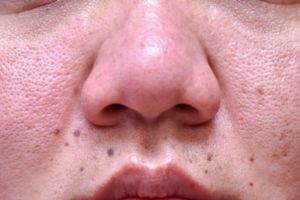 Tanpa kunyit, cara alami buat tekstur kulit mulus dari pori-pori besar dengan 1 sumber protein