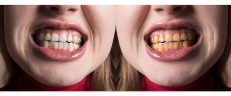 Tak butuh kulit pisang, rahasia gigi putih bebas lubang bisa pakai 1 jenis rempah ini