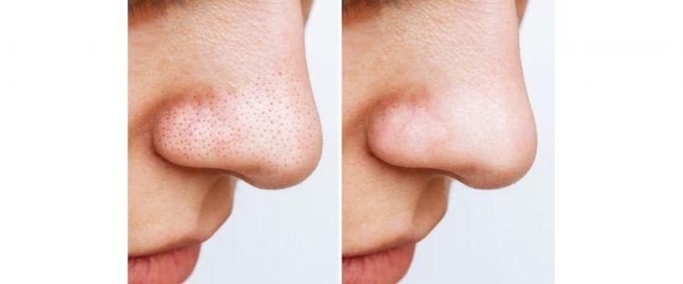 Jangan gunakan pasta gigi, ini cara bikin komedo hidung hilang total pakai kombinasi 2 bahan manis