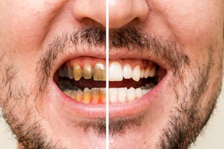 Campuran petroleum jelly dan 1 bahan dapur ini efektif putihkan gigi kuning, begini cara meraciknya