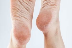 Tanpa minyak zaitun, ini cara haluskan tumit retak agar bak kulit bayi gunakan 1 jenis tanaman herbal