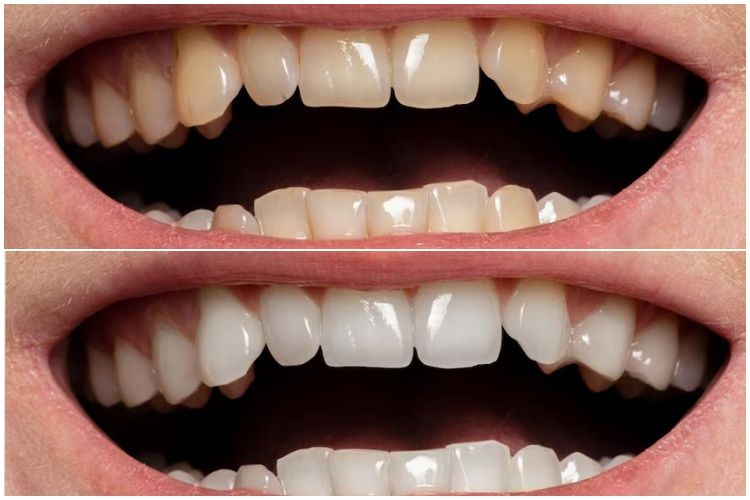 Tak perlu jahe, begini cara praktis hilangkan karang gigi agar tak semakin parah pakai 1 jenis rempah