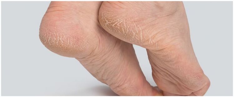 Tak perlu scrub madu, begini cara sederhana atasi tumit kering dan pecah-pecah pakai 2 bahan alami