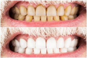 Tak melulu pakai kulit pisang, begini trik memutihkan gigi penuh noda kuning dengan 1 bahan dapur