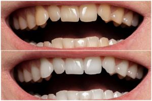 Bukan pakai garam, ternyata begini cara memutihkan gigi kuning membandel cuma pakai 3 jenis buah