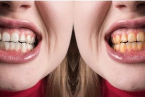 Seperti habis bleaching, begini trik bikin gigi putih cemerlang cuma pakai 1 jenis jenis bumbu dapur