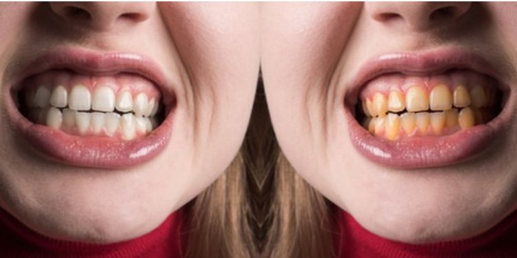 Seperti habis bleaching, begini trik bikin gigi putih cemerlang cuma pakai 1 jenis jenis bumbu dapur