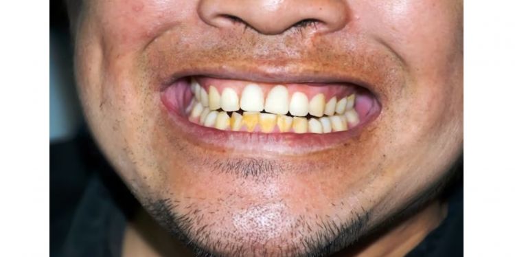 Nggak cuma pakai lemon, begini cara kembalikan warna putih pada gigi cuma pakai 1 jenis lalapan