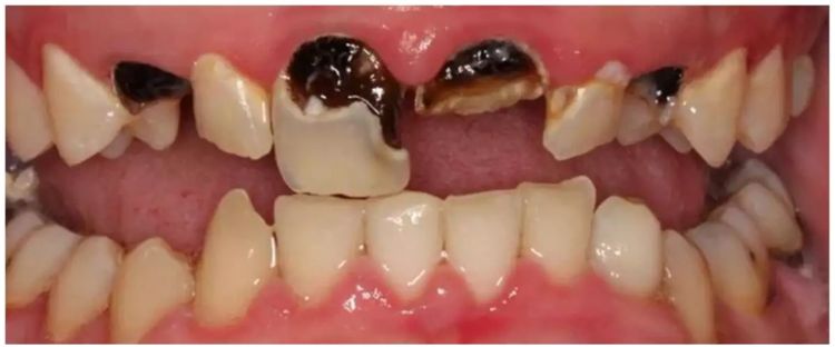 Tak perlu pakai garam, begini cara rontokkan plak hitam di gigi cukup dengan 1 jenis rempah