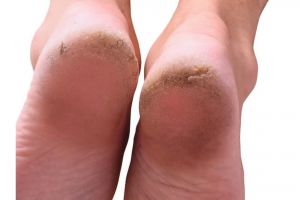 Bukan pakai baking soda, ini trik menghaluskan telapak kaki kasar auto mulus pakai 1 pembersih gigi