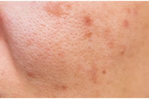 Cara efektif bersihkan pori-pori wajah agar kulit terlihat mulus dengan 1 jenis tepung