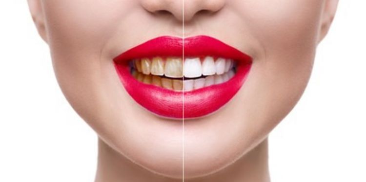 Selain baking soda, begini cara basmi noda kuning agar gigi tak mudah rapuh pakai 1 jenis sampah dapur