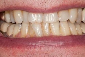 Cuma pakai 1 jenis tepung, begini cara rontokkan plak kuning pada gigi tanpa produk pemutih