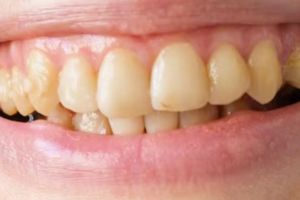 Cuma pakai 1 jenis minuman, begini cara atasi plak gigi membandel ala Jepang tanpan lemon