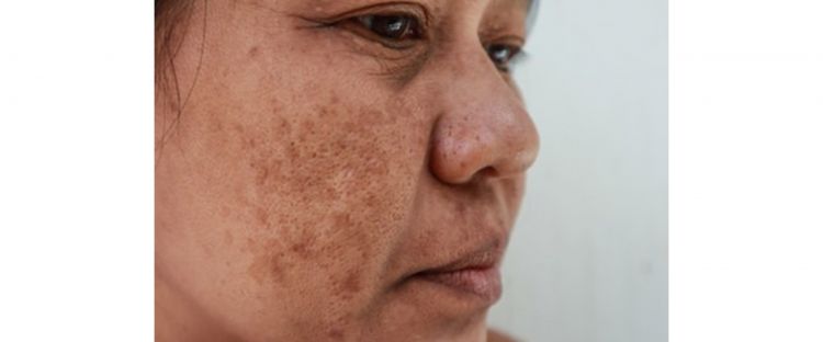 Cara hilangkan flek hitam agar kulit kembali mulus dengan 1 jenis topping minuman