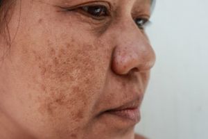 Nggak perlu kopi, begini cara cerahkan flek hitam akibat penggunaan skincare pakai 2 bahan alami