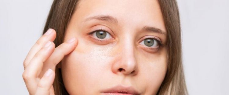 Cara hilangkan dark circle dan kantung mata dengan 1 jenis bahan pemanis
