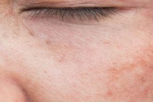 Bukan cuma air beras, ini cara hapus noda hitam gegara sering panas-panasan cuma pakai 1 kulit buah