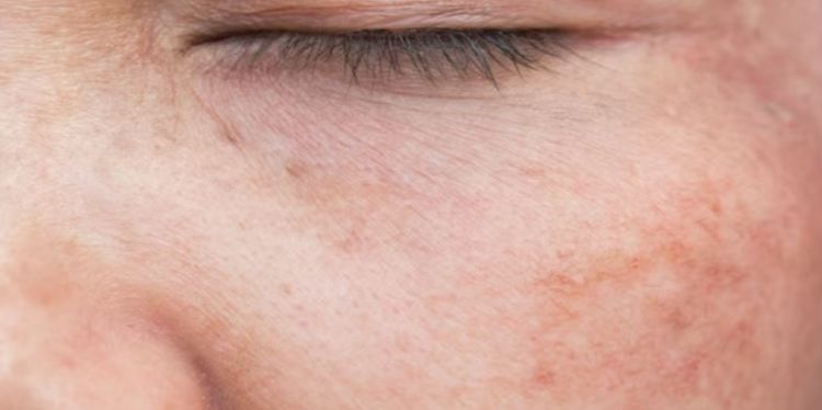 Bukan cuma air beras, ini cara hapus noda hitam gegara sering panas-panasan cuma pakai 1 kulit buah