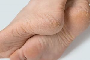 Selain pakai petroleum jelly, begini cara hilangkan tumit kaki pecah-pecah pakai 1 jenis lilin