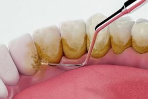 Nggak repot scaling, ini cara luruhkan noda kuning dan plak agar gigi jadi putih pakai 2 bahan dapur