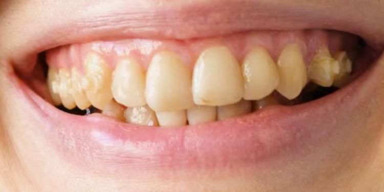 Bukan pakai garam dan baking soda, ini trik putihkan gigi kekuningan dengan 1 jenis ranting pohon