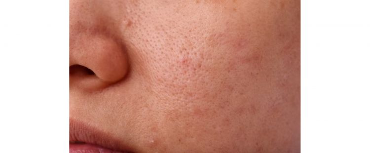 Trik sederhana menghaluskan wajah dan mengecilkan pori-pori dengan 1 kulit buah