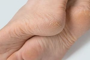 Cara menghaluskan tumit pecah-pecah gunakan 1 jenis buah, bukan pakai madu maupun cuka apel