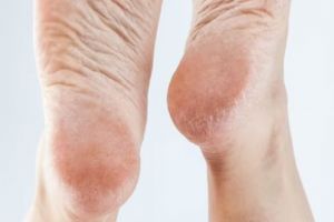 Cara simpel muluskan tumit kaki retak pakai 1 alat penerangan, dijamin mulus dalam sekejap