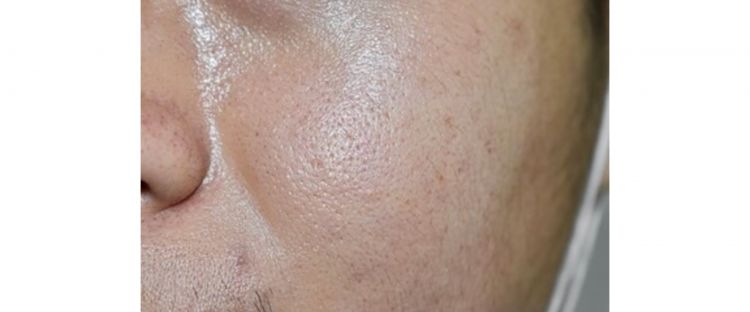 Tanpa ampas kopi, begini trik ampuh mengecilkan pori-pori besar dan hilangkan minyak berlebih di wajah