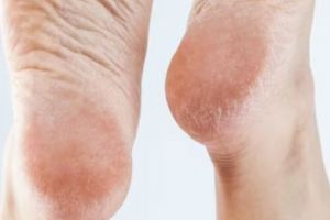 Cara haluskan tumit kaki pecah-pecah menghitam cuma pakai 1 bahan herbal, auto halus dalam 10 menit