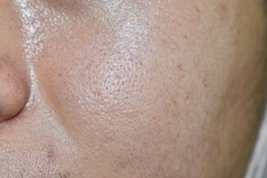 Cara bikin pori-pori rapat dan bersih dari kotoran pakai 1 jenis minuman, kulit mulus dalam sekejap