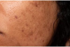 Cara meratakan warna kulit dari flek hitam pakai 1 jenis minuman, nggak ribet tanpa skincare