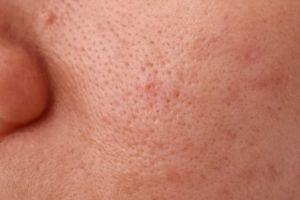 Cara kecilkan pori-pori agar wajah bebas minya pakai 1 bahan masak, nggak beli lagi beli porepack