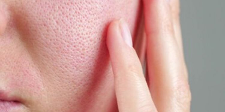 Cara atasi pori-pori besar di wajah pakai 1 kulit buah, halus tanpa madu