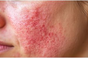 Cara mengatasi iritasi dan kemerahan di wajah ini ampuh bikin halus pakai masker dari 2 bahan dapur